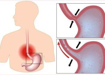 Воспаление слизистой пищевода из-за попадания кислоты из желудка в пищевод через пищеводное отверстие.