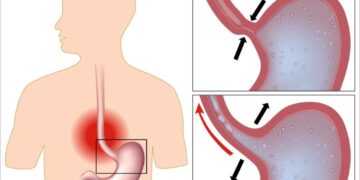Воспаление слизистой пищевода из-за попадания кислоты из желудка в пищевод через пищеводное отверстие.