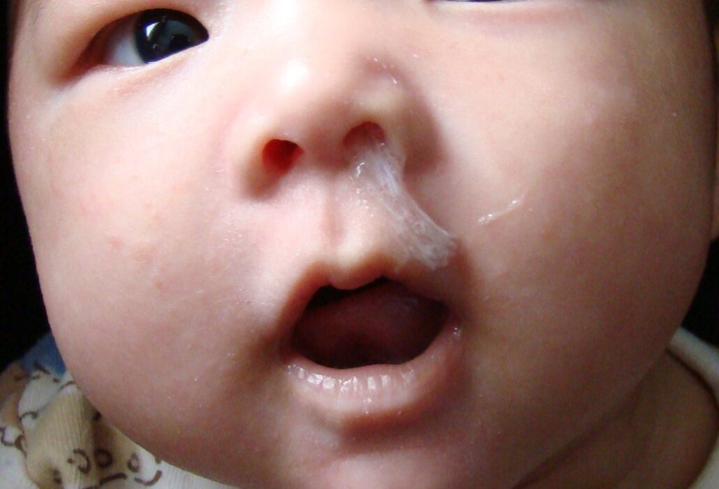 Белые сопли водянистой структуры - первые симптомы появления вредоносных микробов в носовых пазухах