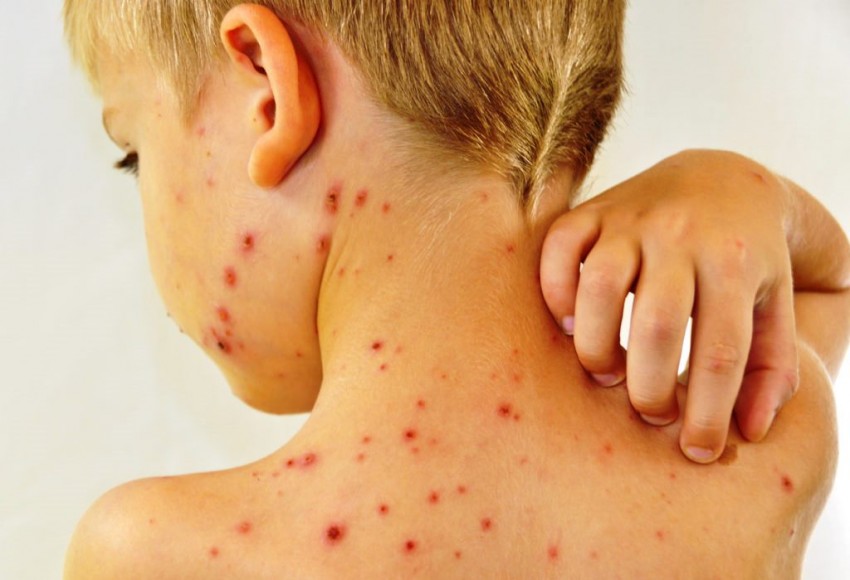 Симптомы стрептодермии могут маскироваться под другие кожные заболевания
