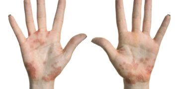 Руки, пораженные псориазными бляшками