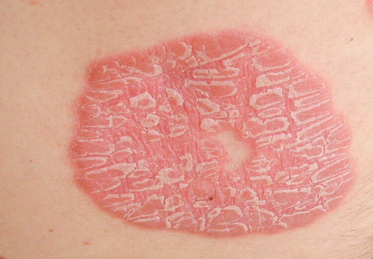 Шелушащаяся бляшка на коже