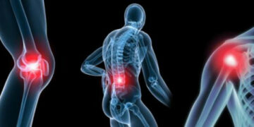 Артралгия: локализация