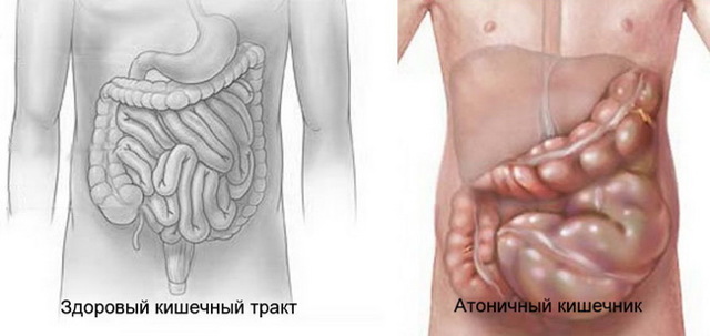 Атония кишечника - часто встречающийся диагноз