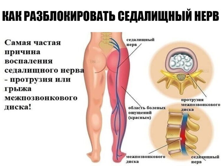 Разблокировать воспаление седалищного нерва поможет комплекс процедур, назначенный невропатологом