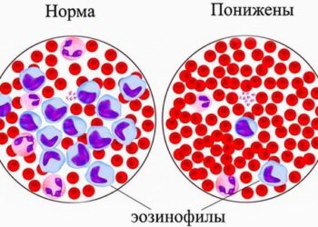 Наглядный пример превышения нормы эозинофилов