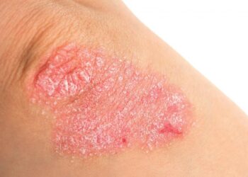 Высыпания при розовом лишае