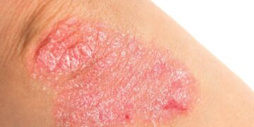 Высыпания при розовом лишае