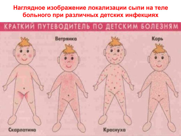 Изменения на теле при скарлатине в сравнении со сходными по симптоматиками детскими инфекциями