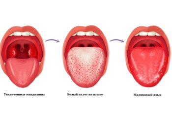 Увеличение миндалин и изменение окраски языка – один их характерных признаков скарлатины