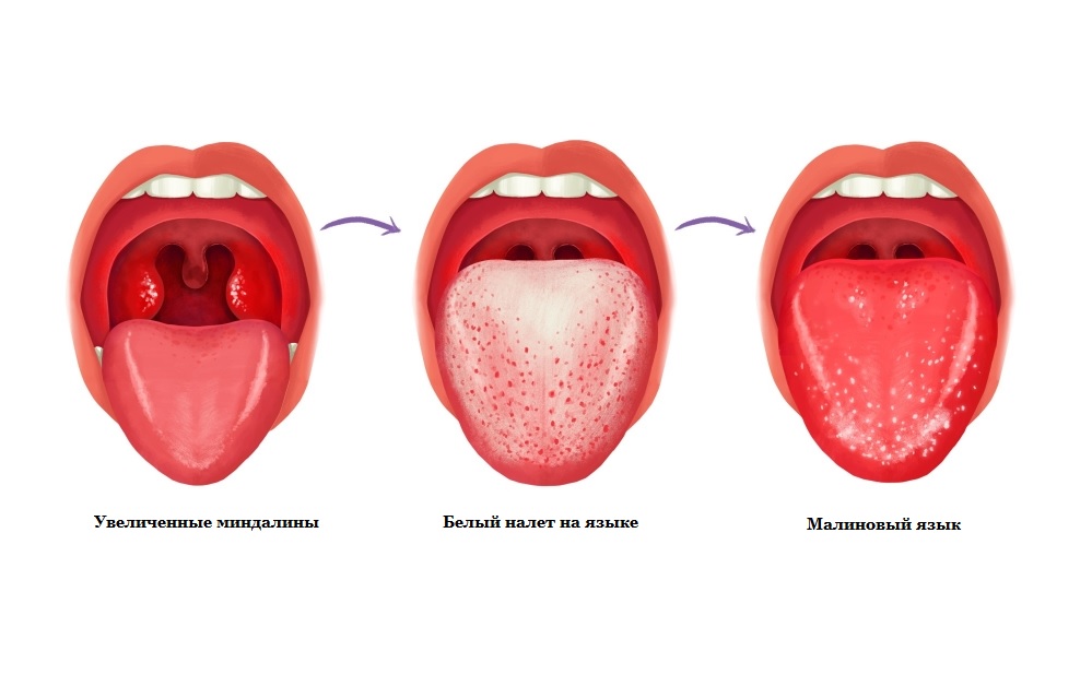 Увеличение миндалин и изменение окраски языка – один их характерных признаков скарлатины