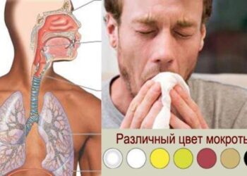 Опытный врач может по цвету мокроты диагностировать заболевание