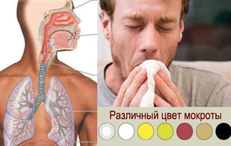 Опытный врач может по цвету мокроты диагностировать заболевание