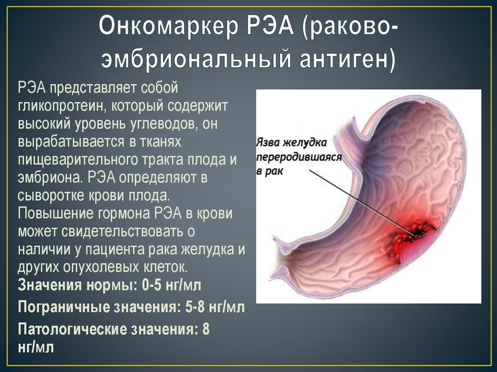 РЭА как онкомаркер злокачественных новообразований