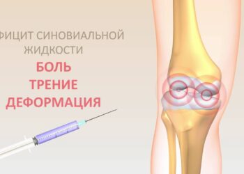 Симптоматика недостатка синовиальной жидкости
