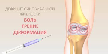 Симптоматика недостатка синовиальной жидкости