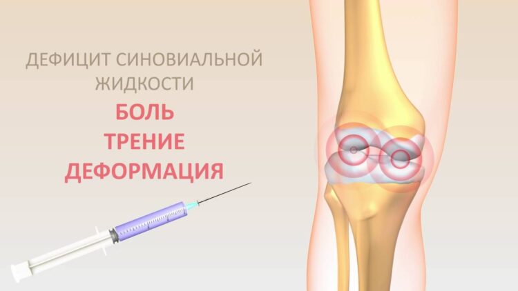 Симптоматика недостатка синовиальной жидкости