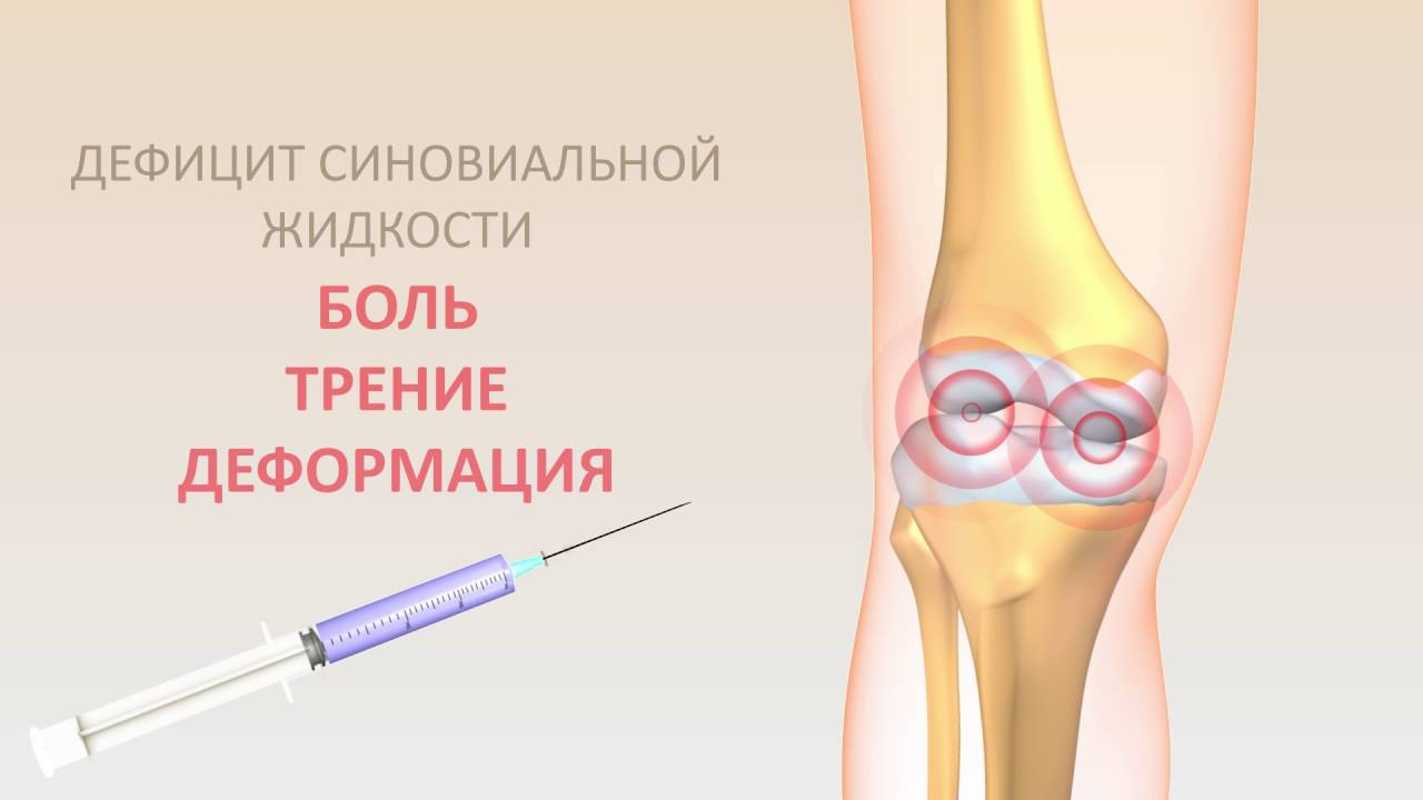 Что такое синовиальная жидкость и где она располагается? | ЧИРП.RU