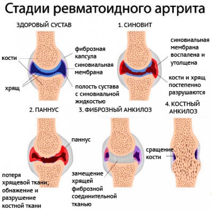 Ревматоидный артрит характеризуется симметричным поражением суставов