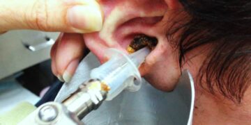 Лечить зуд в ушах, удалять серные пробки должен ЛОР-врач