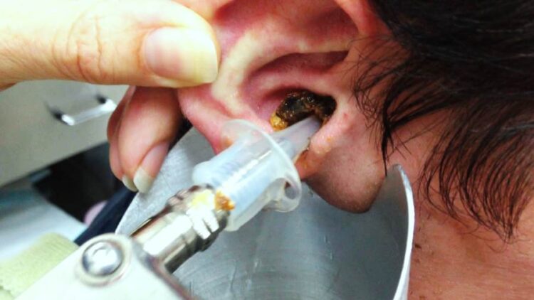 Лечить зуд в ушах, удалять серные пробки должен ЛОР-врач