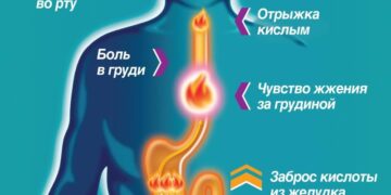 Пять основных симптомов изжоги у человека