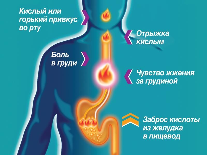Пять основных симптомов изжоги у человека